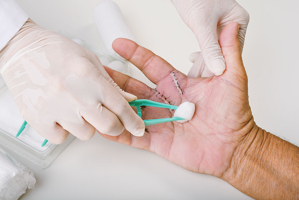 A doctor cleaning stitches on the palm of a man’s hand.